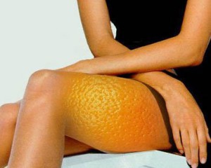 Целлюлит. Как от него избавиться?